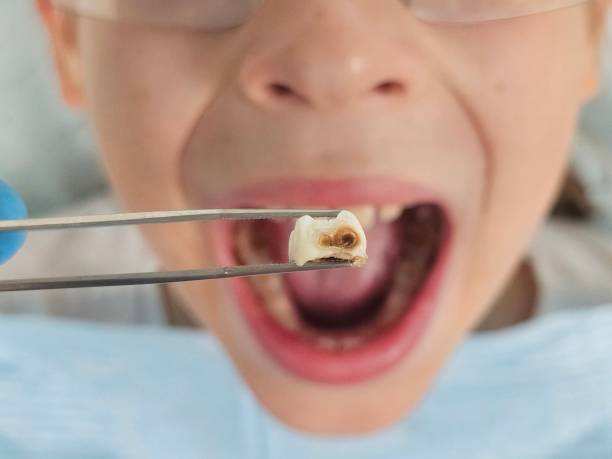 Best Emergency Broken Tooth Repair in North Ogden, UT